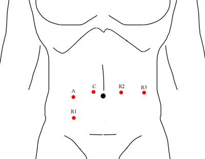 Learning Curve of Robotic-Assisted Total Mesorectal Excision for Rectal Cancer